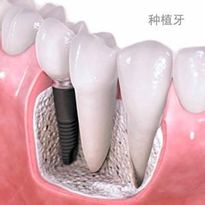 德国精密种植牙：成功实现无痛种牙