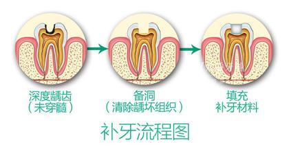 补牙你需要知道的那些事儿