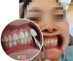 蓝光美白让我收获甜蜜爱情